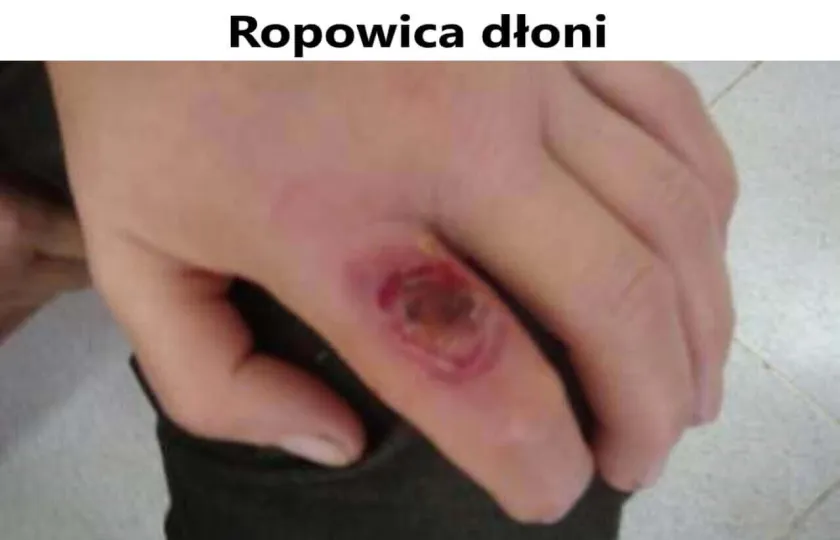 Ropowica dłoni