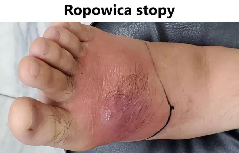 Ropowica stopy