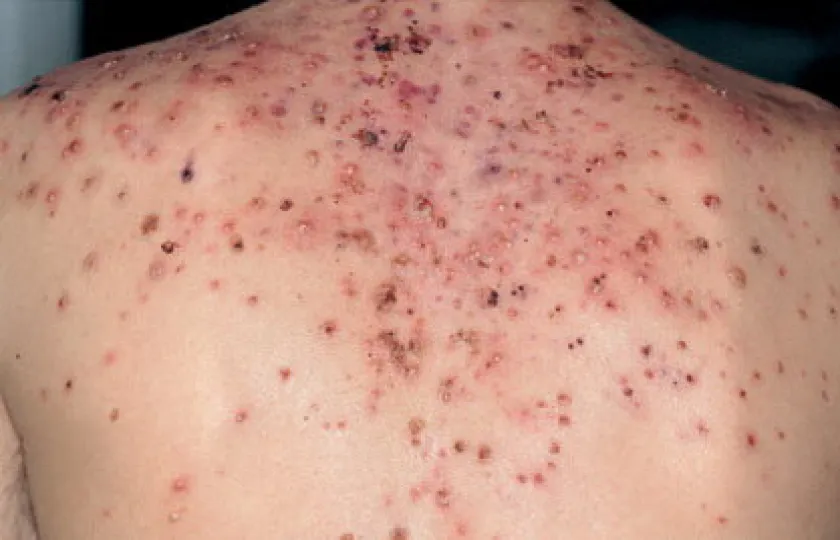 trądzik piorunujący