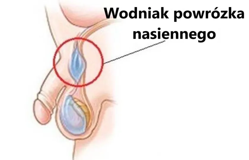 Wodniak powrózka nasiennego