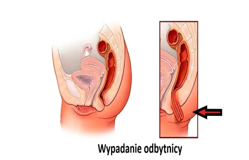 Wypadanie odbytnicy