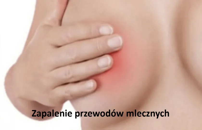 Zapalenie przewodów mlecznych