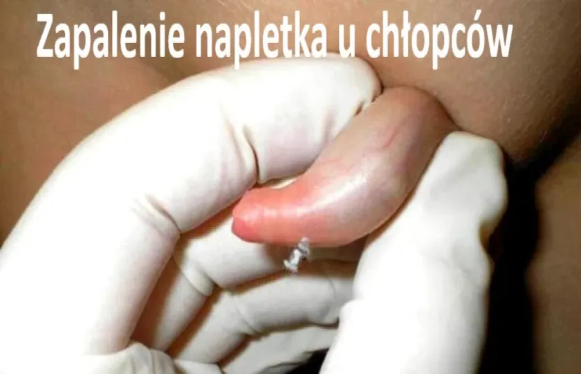 zapalenie napletka u chłopców