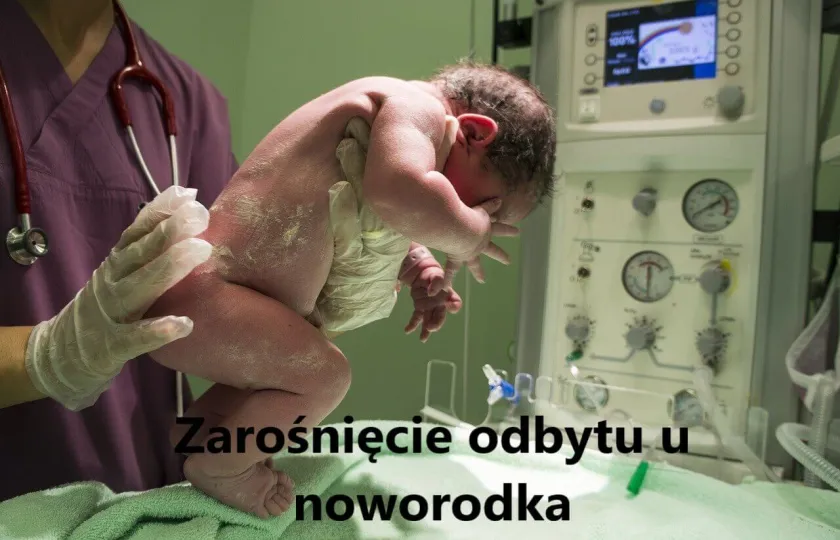 zarośnięcie odbytu, atrezja odbytu odbytnicy, zarośnięcie odbytu u noworodka