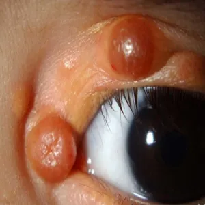 Łagodne zmiany guzkowe powiek