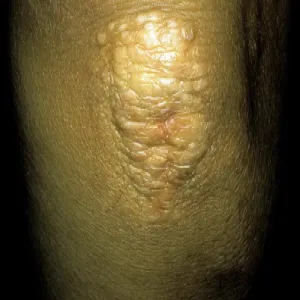 Łokieć zmiany skórne kępki żółte guzkowe 