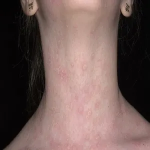 Łupież różowy Giberta na szyi