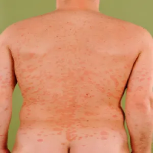 Łupież różowy Giberta