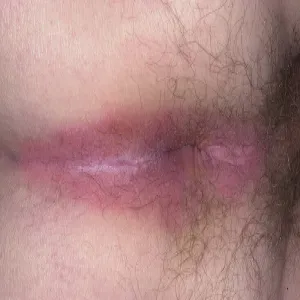 Łuszczyca w okolicy odbytu 