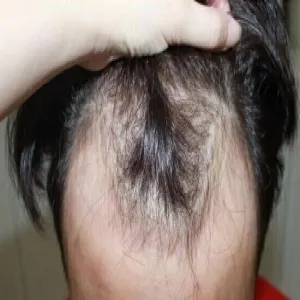 Łysienie androgenowe typu męskiego choroba