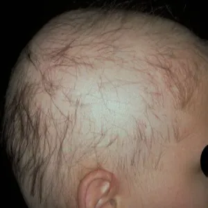 Łysienie plackowate u dzieci