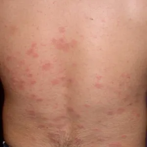 łupież różowy giberta zdjęcia