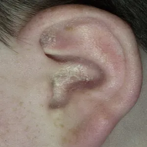 łuszcząca się skóra w uchu