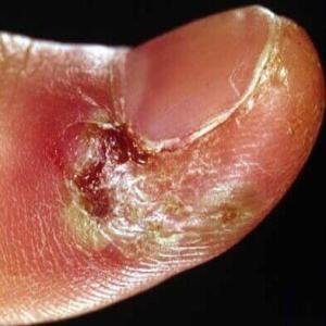 łuszczenie się skóry wokół zanokcicy