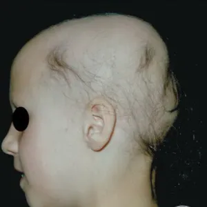 łysienie plackowate u dzieci zdjęcia