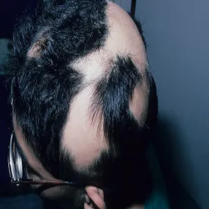 łysienie plackowate zdjęcie