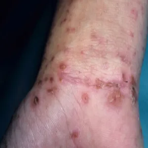 Świerzb na nadgarstku