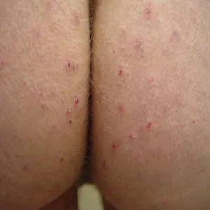 Świerzb na pośladkach