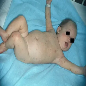 Świerzb u dzieci objawy