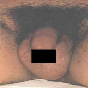 Świnkowe zapalenie jąder