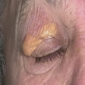 Żółta narośl na powiece kępki żółte 
