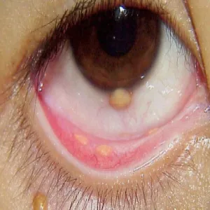 Żółtakoziarniniak młodzieńczy oko