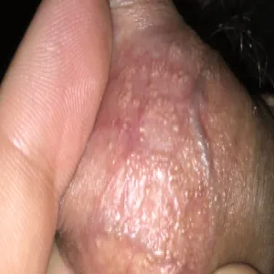 Żółte plamki grudki na prąciu zdjęcia