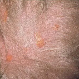 Żółte plamy na skórze głowy u dziecka