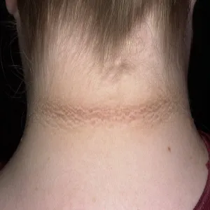 Acanthosis nigricans