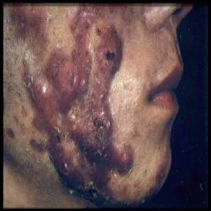Acne conglobata 