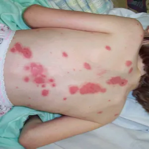 Alergia na lek u dzieci zespół Stevensa- Johnsona