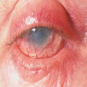 Alergia na lek u objawy oczne zespół Stevensa- Johnsona