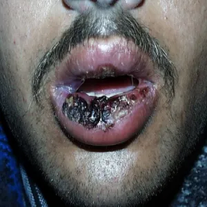 Alergia na leki objawy na ustach