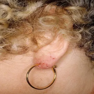 Alergiczne kontaktowe zapalenie skóry na złoto