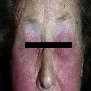 Alergiczne kontaktowe zapalenie skóry twarzy