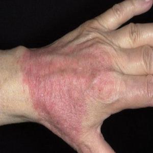 Alergiczne kontaktowe zapalenie skóry wywołane innymi środkami chemicznymi
