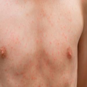 Alergiczne kontaktowe zapalenie skóry wywołane innymi czynnikami
