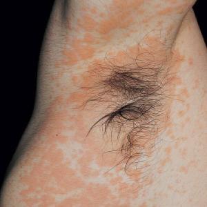 Alergiczne kontaktowe zapalenie skóry wywołane przez kontakt leków ze skórą