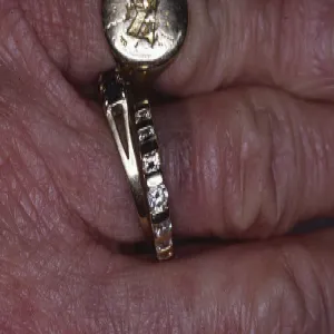 Alergiczne kontaktowe zapalenie skóry wywołane przez kontakt z metalami