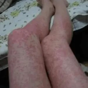 Alergiczne kontaktowe zapalenie skóry o nieokreślonej przyczynie