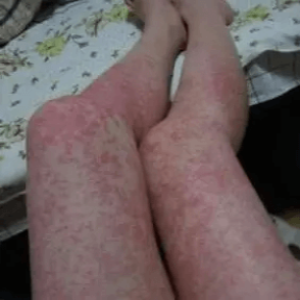 Alergiczne kontaktowe zapalenie skóry o nieokreślonej przyczynie