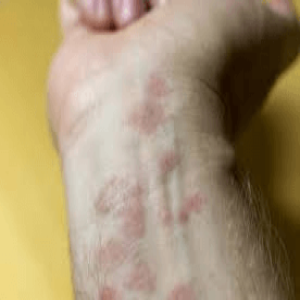 Alergiczne kontaktowe zapalenie skóry wywołane kontaktem pokarmu ze skórą