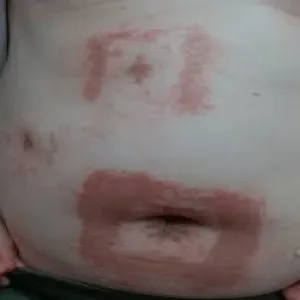 Alergiczne kontaktowe zapalenie skóry wywołane przez przylepiec