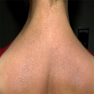 Amyloidoza skóry plecy szyja