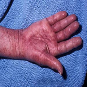Amyloidozy skóry dłoni