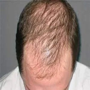Androgenetic alopecia