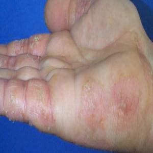 Atopowe zapalenie skóry na dłoni