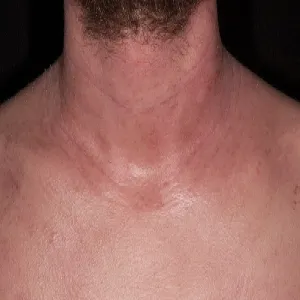 Atopowe zapalenie skóry na szyi zdjęcie