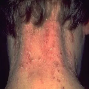 Atopowe zapalenie skóry na szyi