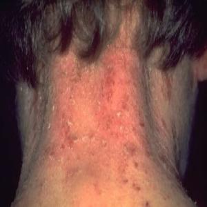 Atopowe zapalenie skóry na szyi